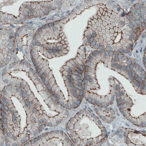 Staining of human prostate cancer shows membranous positivity in tumor cells.