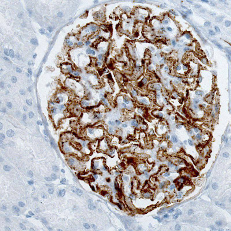 Staining of human kidney (idiopathic membranous nephropathy) shows strong membranous positivity in cells in glomeruli.