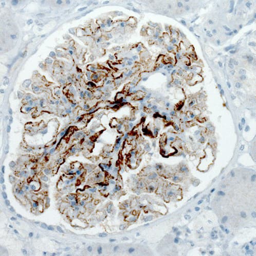 Staining of human kidney (idiopathic membranous nephropathy) shows strong membranous positivity in cells in glomeruli.
