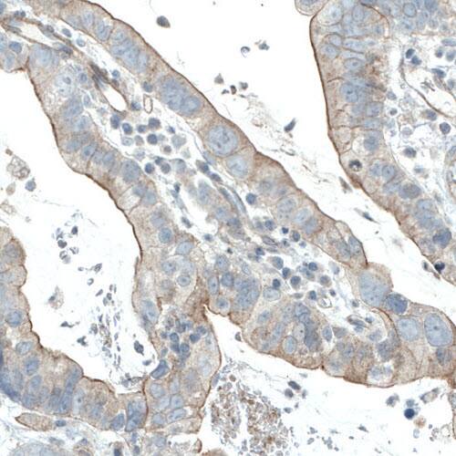 Staining of human ventricular cancer shows moderate membranous immunoreactivity in tumor cells.