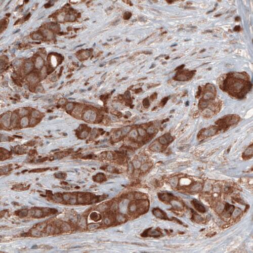 Staining of human breast cancer shows cytoplasmic immunoreactivity in tumor cells.