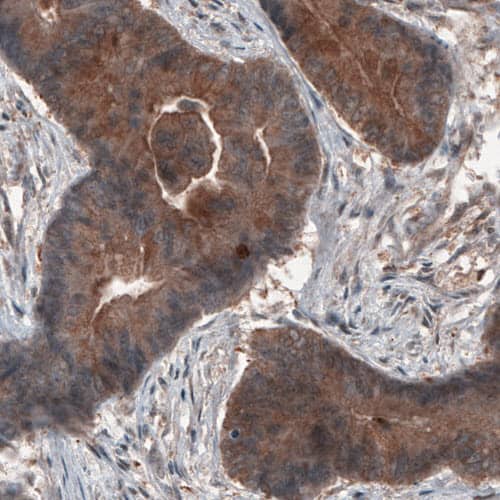 Staining of human colorectal cancer shows cytoplasmic immunoreactivity in tumor cells.