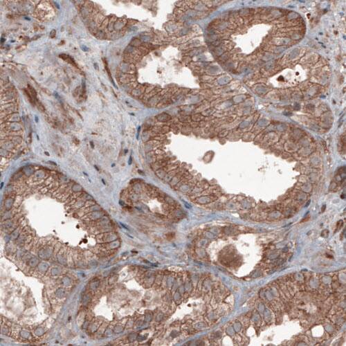Staining of human prostate cancer shows moderate cytoplasmic positivity in tumor cells.