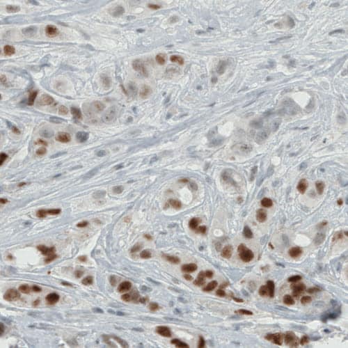 Staining of human breast cancer shows moderate to strong nuclear positivity in a subset of tumor cells.