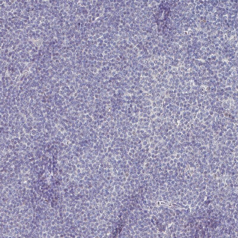 Staining of human chronic lymphocytic leukemia shows no nuclear positivity in tumor cells as expected.