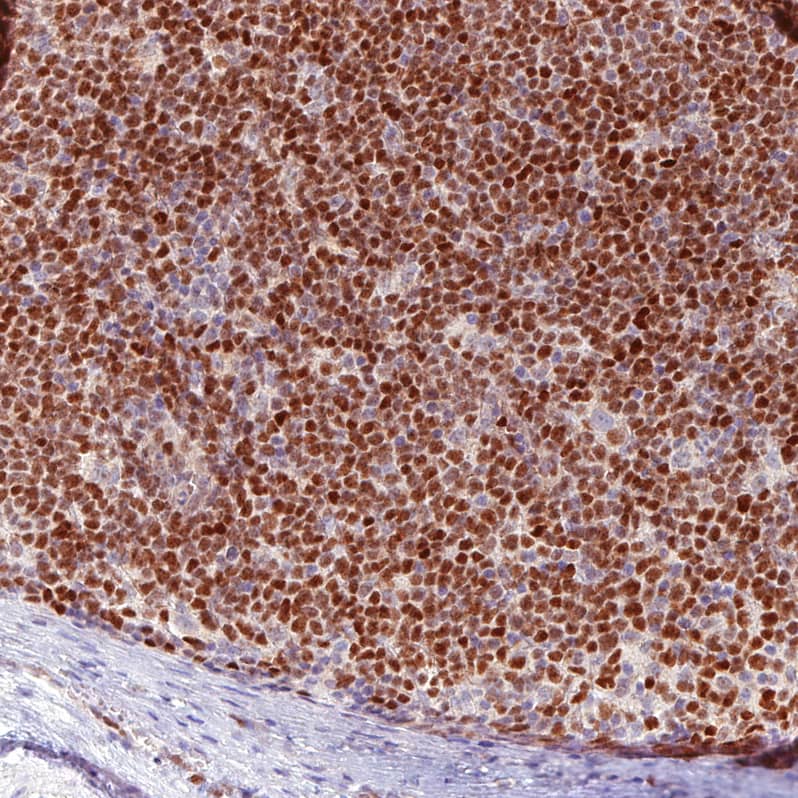 Staining of human mantle cell lymphoma shows moderate to strong nuclear positivity in tumor cells.