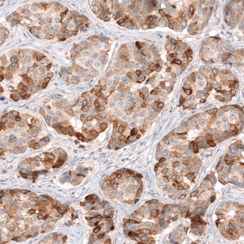 Staining of human breast cancer shows moderate to strong cytoplasmic positivity in tumor cells.