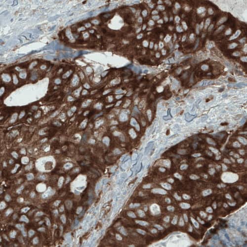 Staining of human colorectal cancer shows strong cytoplasmic immunoreactivity in tumor cells.