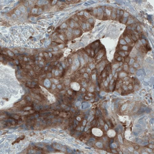 Staining of human colorectal cancer shows strong cytoplasmic immunoreactivity in tumor cells.