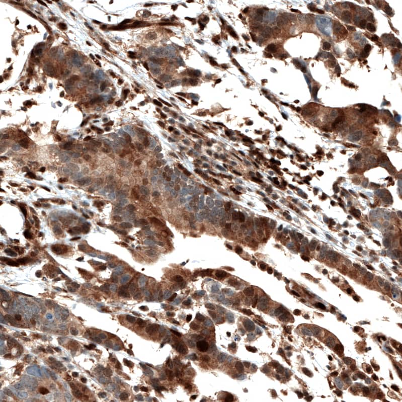 Staining of human stomach cancer shows moderate to strong nuclear and cytoplasmic positivity in a subset of tumor cells.