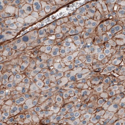 Staining of human liver cancer shows strong positivity in tumor.