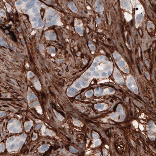 Staining of human breast cancer shows strong immunoreactivity in tumor stroma.