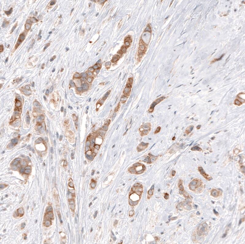 Staining of human breast cancer shows moderate cytoplasmic positivity in tumor cells.