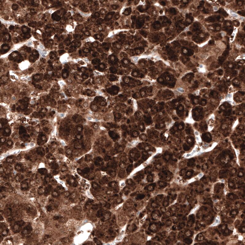 Staining of human liver cancer shows strong cytoplasmic positivity in tumor cells.