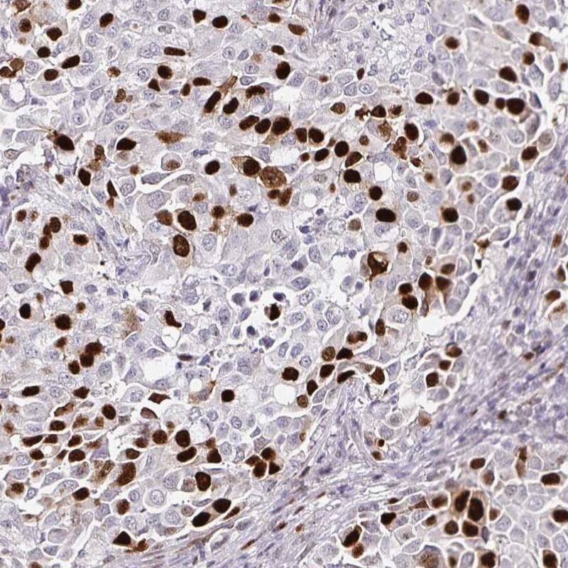 Staining of human lung cancer shows moderate to strong nuclear positivity in a subset of tumor cells.