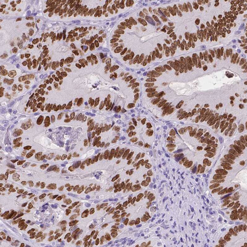 Staining of human colorectal cancer shows strong nuclear positivity in tumor cells.