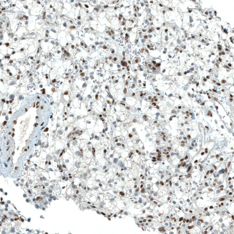 Staining of human kidney cancer shows moderate to strong nuclear positivity in tumor cells.
