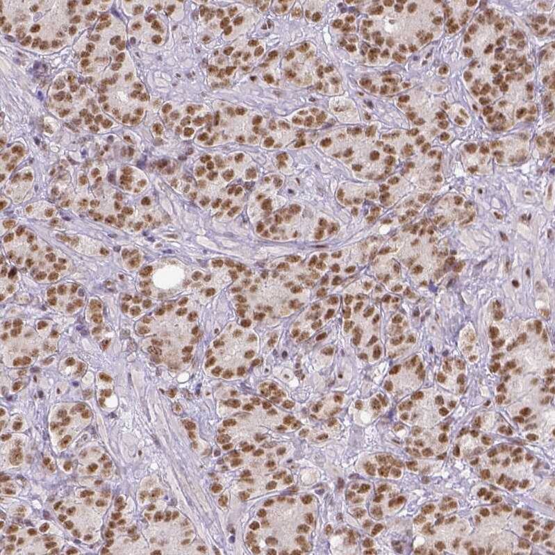 Staining of human prostate cancer shows moderate nuclear positivity in tumor cells.
