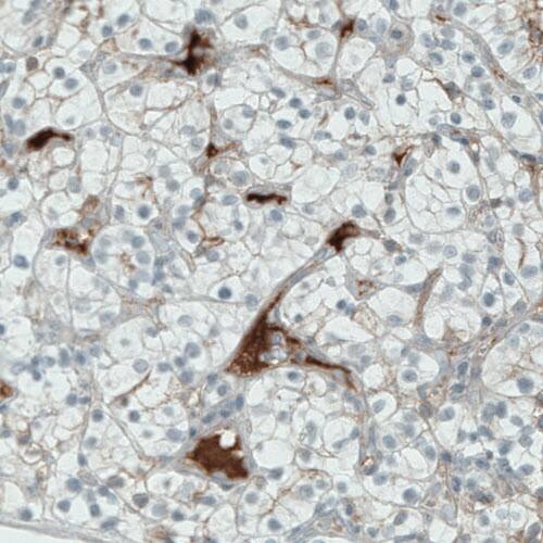 Staining of human kidney (renal cancer) shows strong positivity in plasma in blood vessels.
