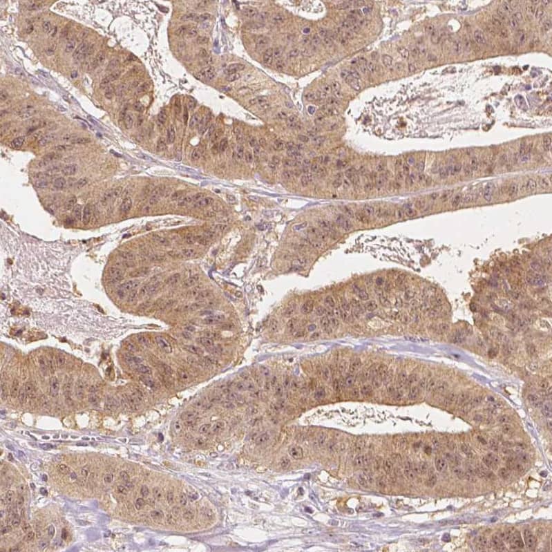 Staining of human colorectal cancer shows moderate cytoplasmic positivity in tumor cells.