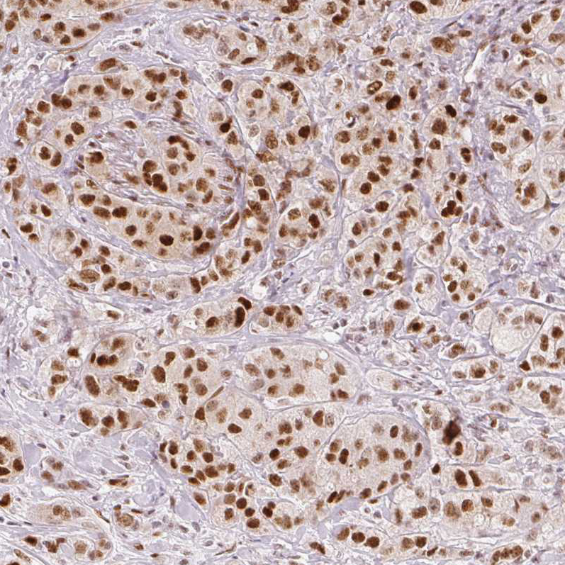 Staining of human breast cancer shows moderate to strong nuclear positivity in tumor cells.