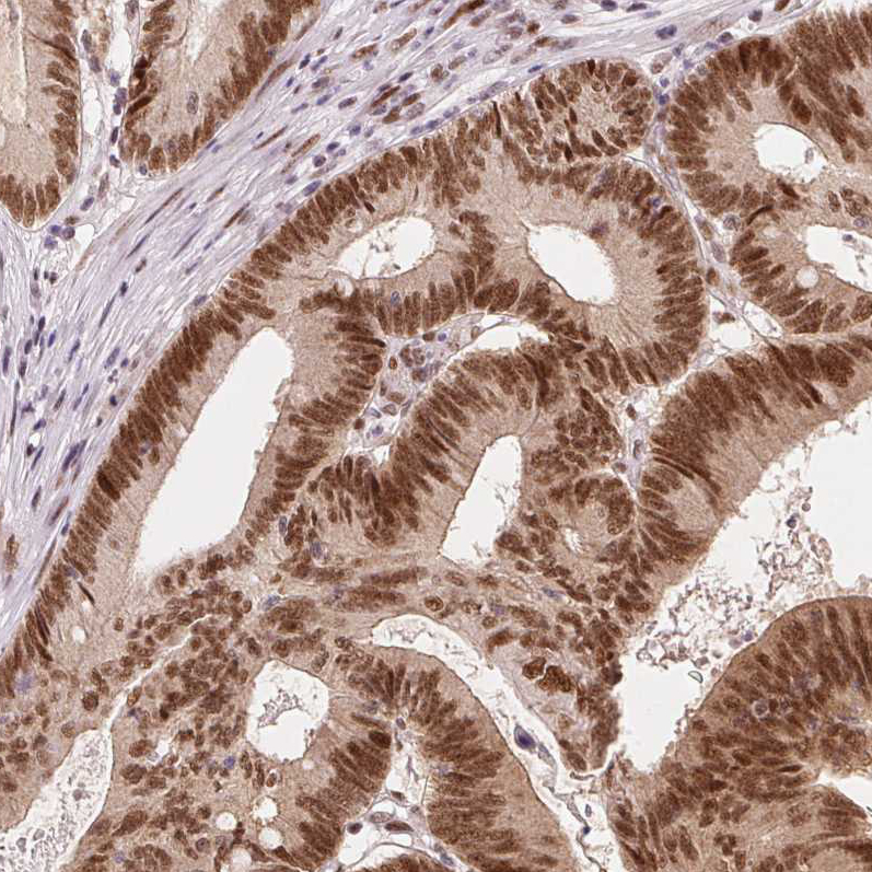 Staining of human colorectal cancer shows strong nuclear positivity in tumor cells.