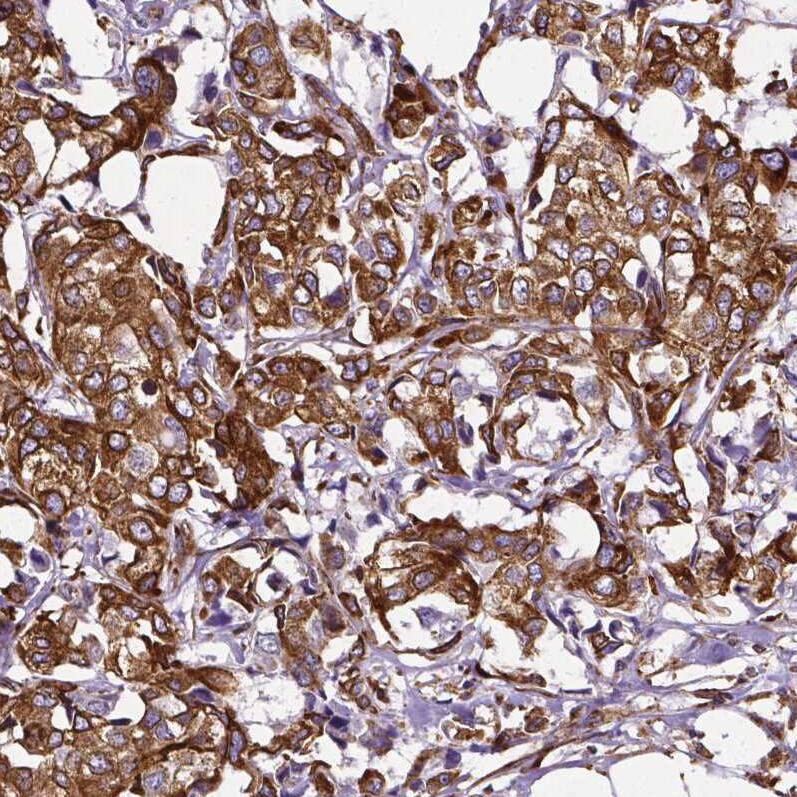 Staining of human breast cancer shows strong cytoplasmic positivity in tumor cells.