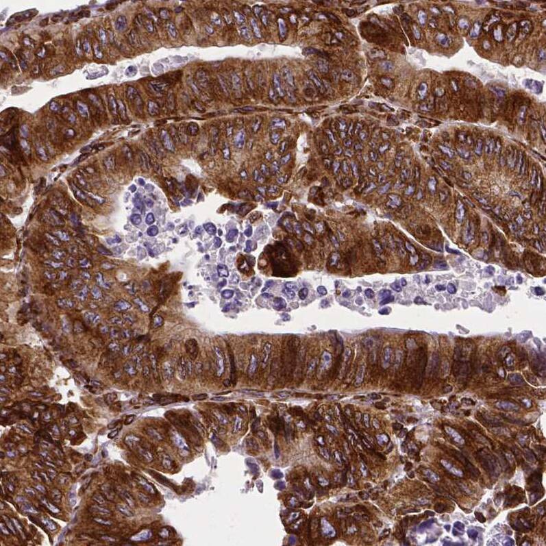 Staining of human colorectal cancer shows strong cytoplasmic positivity in tumor cells.