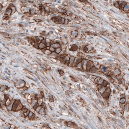 Staining of human breast cancer shows membranous immunoreactivity in tumor cells.