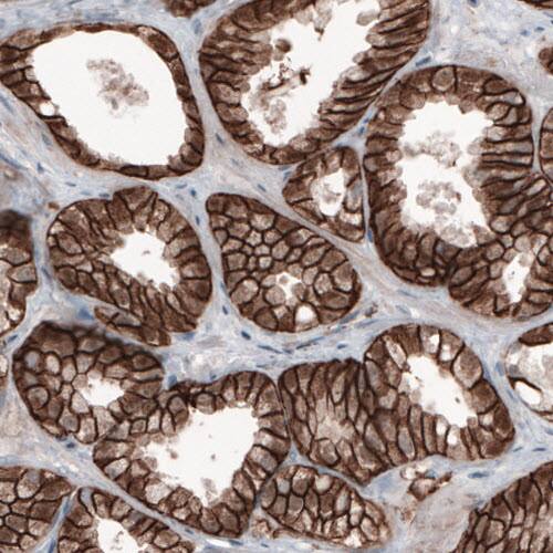 Staining of human prostate cancer shows membranous positivity in tumor cells.
