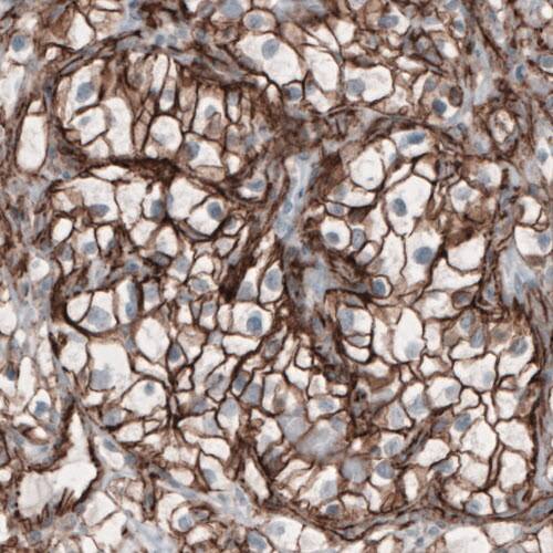 Staining of human renal cancer shows membranous positivity in tumor cells.
