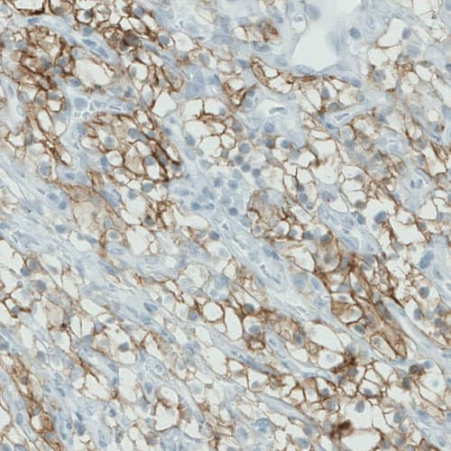 Staining of human renal cancer shows membranous positivity in tumor cells.