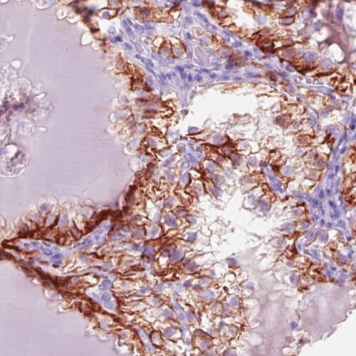 Staining of human kidney (renal cancer) shows moderate immunoreactivity in cancer cells.