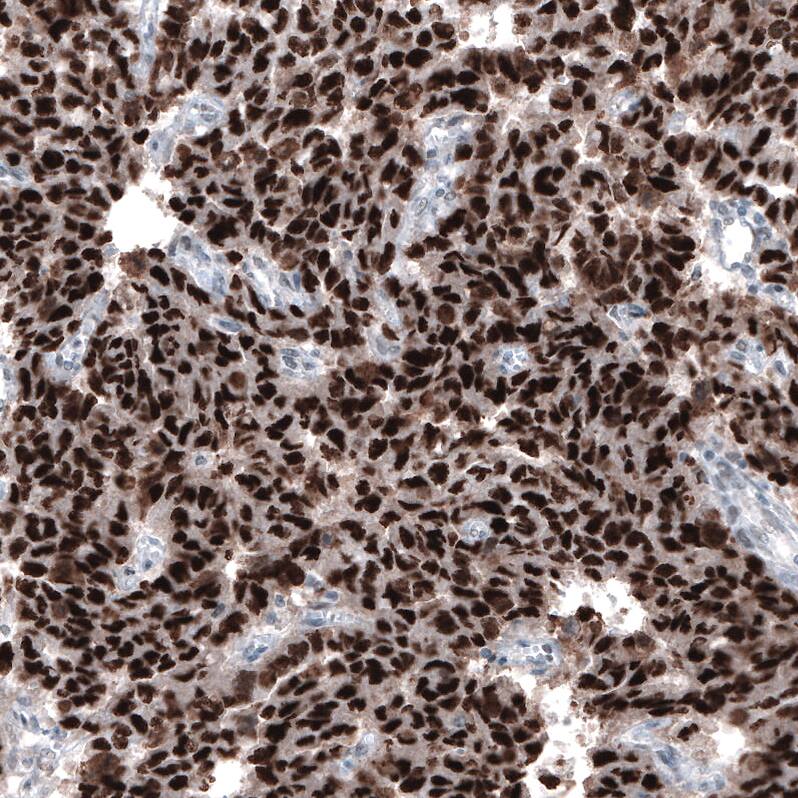 Staining of human  embryonal carcinoma of testis shows strong nuclear positivity.