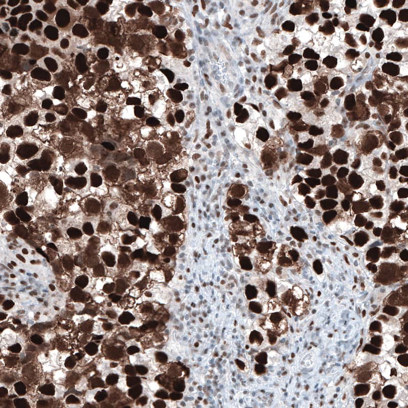 Staining of human testis cancer, seminoma shows strong nuclear positivity.