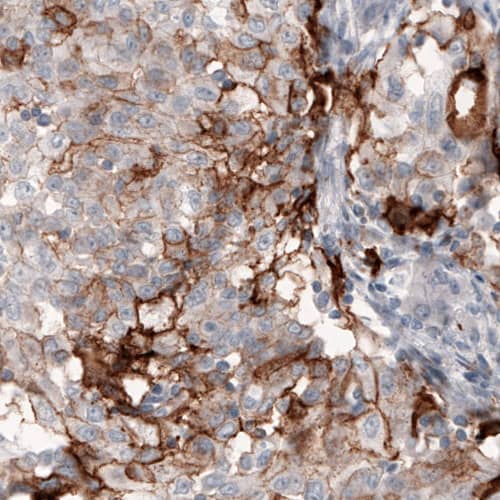 Staining of human lung cancer shows strong immunoreactivity in a subset of cells.