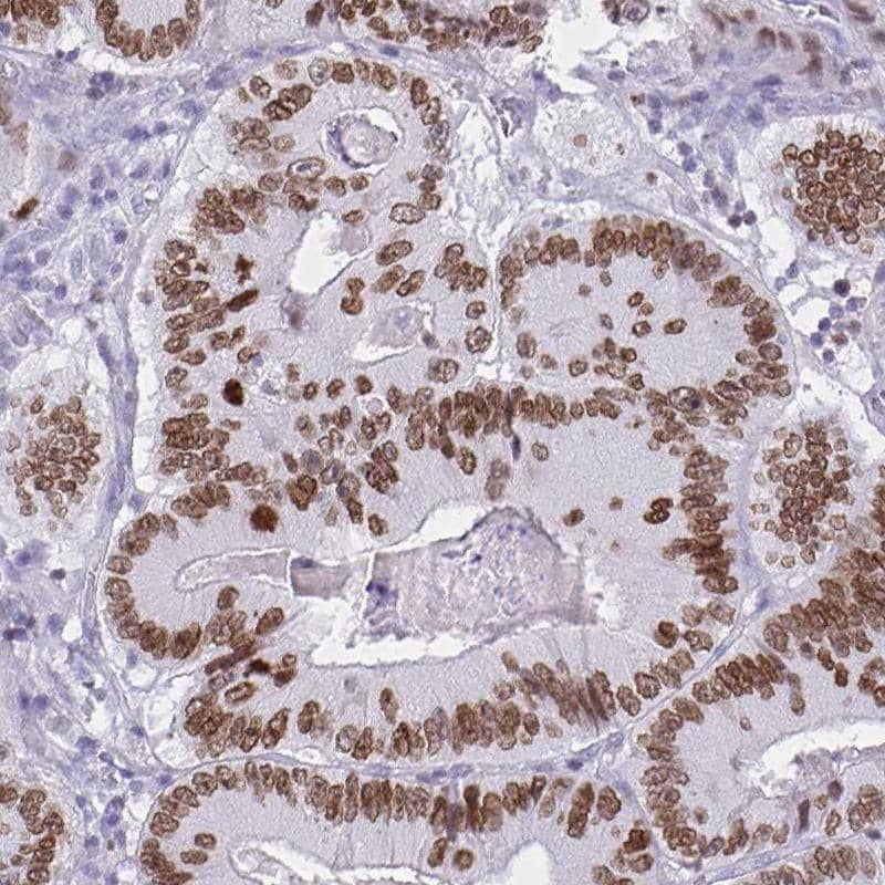 Staining of human colorectal cancer shows moderate to strong nuclear positivity in tumor cells.