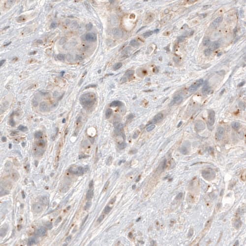 Staining of human breast cancer shows centrosome-like immunoreactivity in tumor cells.