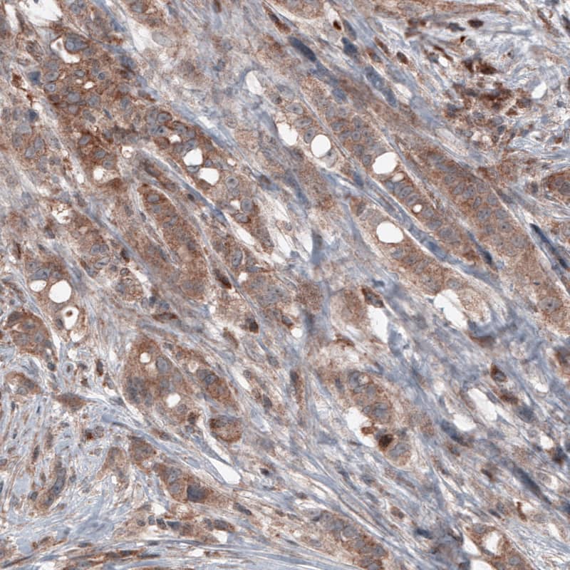 Staining of human breast cancer shows moderate cytoplasmic immunoreactivity in tumor cells.