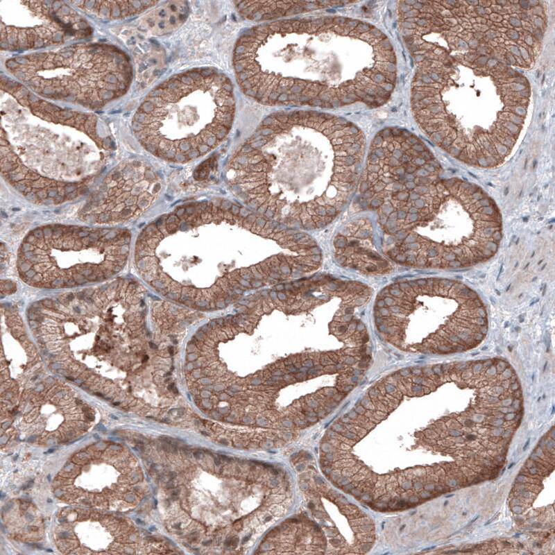Staining of human prostate cancer shows moderate cytoplasmic immunoreactivity in tumor cells.