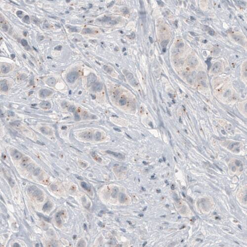 Staining of human breast cancer shows centrosome-like immunoreactivity in tumor cells.