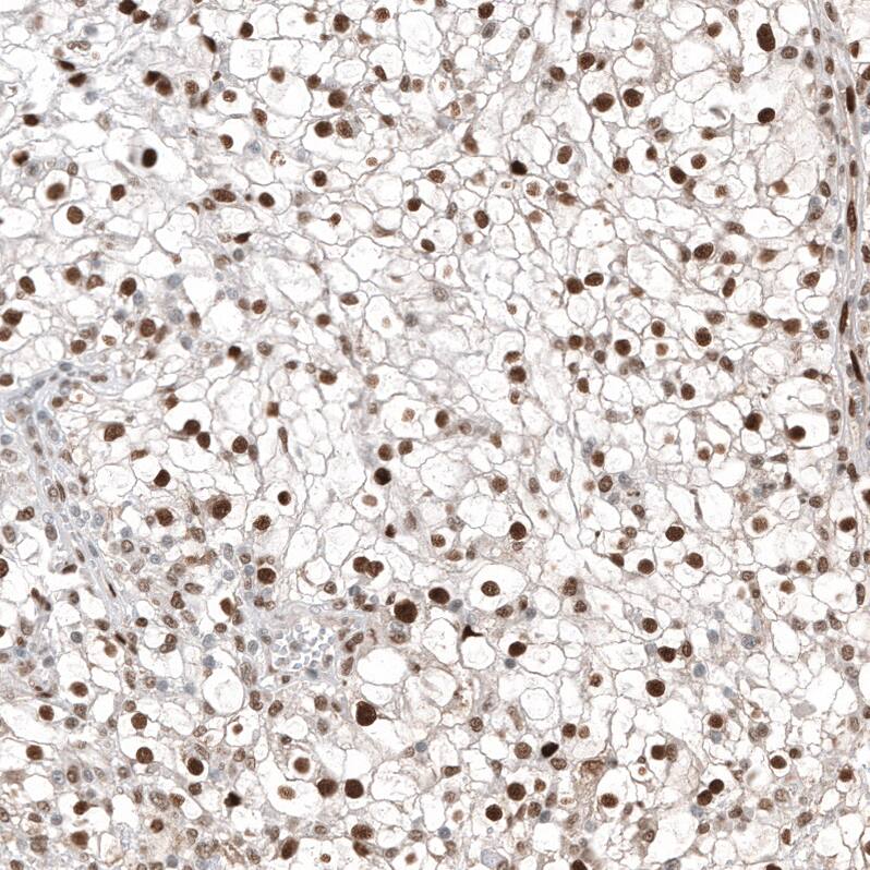 Staining of human kidney cancer shows strong nuclear positivity in tumor cells.