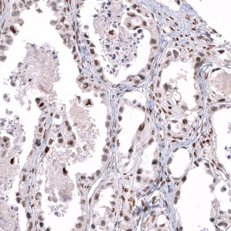 Staining of human ovarian cancer (clear cell carcinoma) shows moderate nuclear positivity in tumor cells.