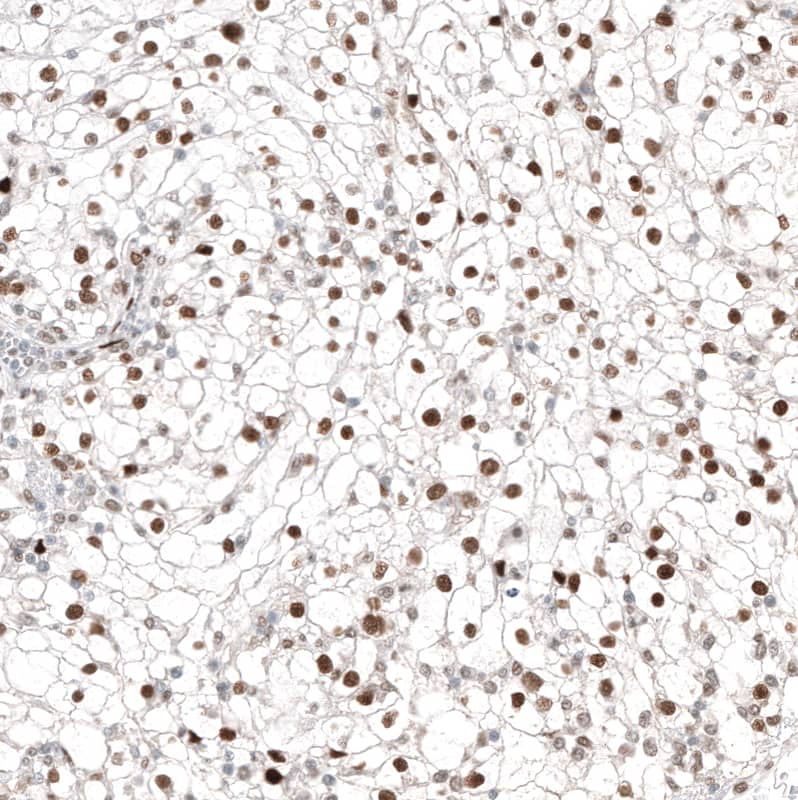 Staining of human kidney cancer shows strong nuclear positivity in tumor cells.
