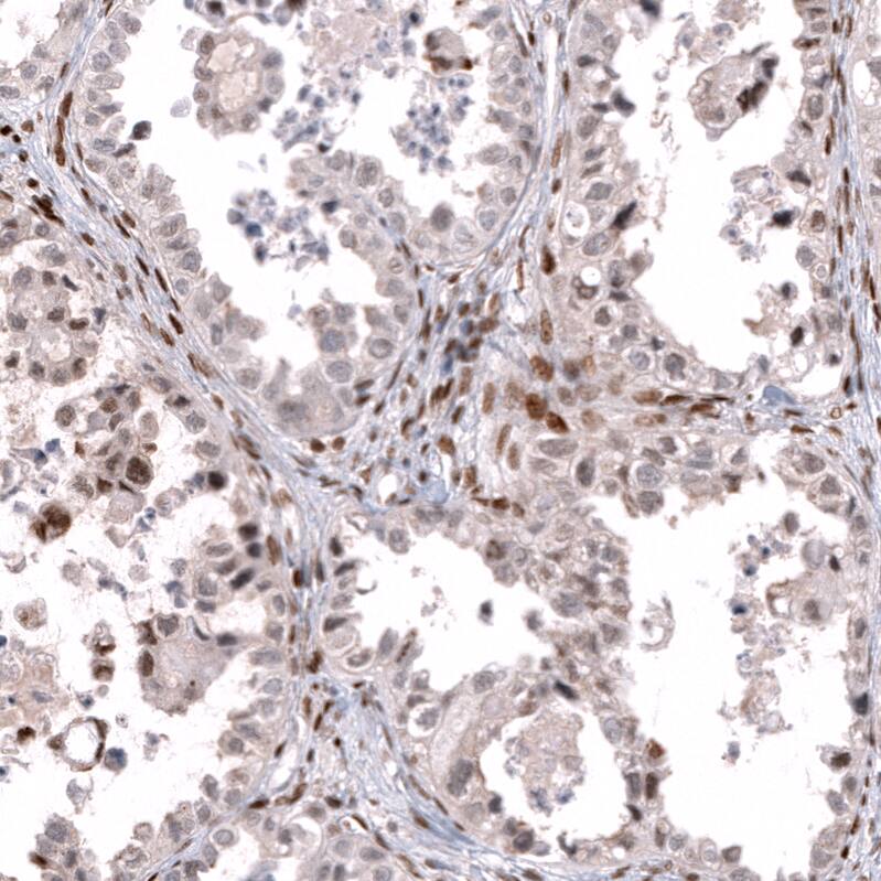 Staining of human ovarian cancer (clear cell carcinoma) shows moderate nuclear positivity in a subset of tumor cells.