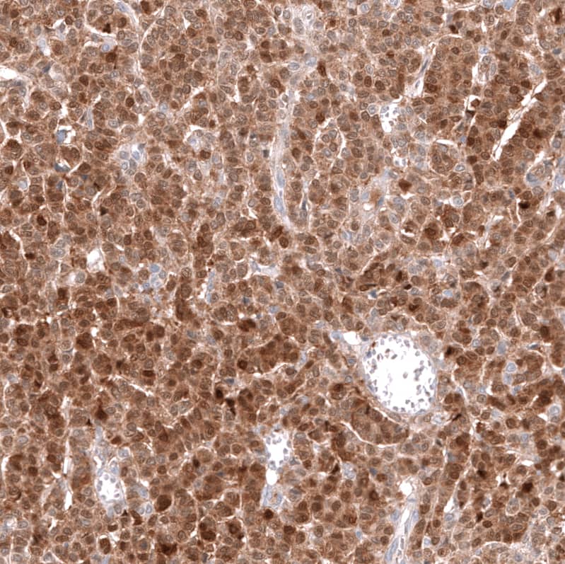 Staining of human ovarian cancer (granular cell carcinoma) shows moderate cytoplasmic positivity in tumor cells.