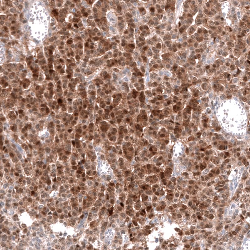 Staining of human ovarian cancer (granular cell carcinoma) shows moderate cytoplasmic positivity in tumor cells.