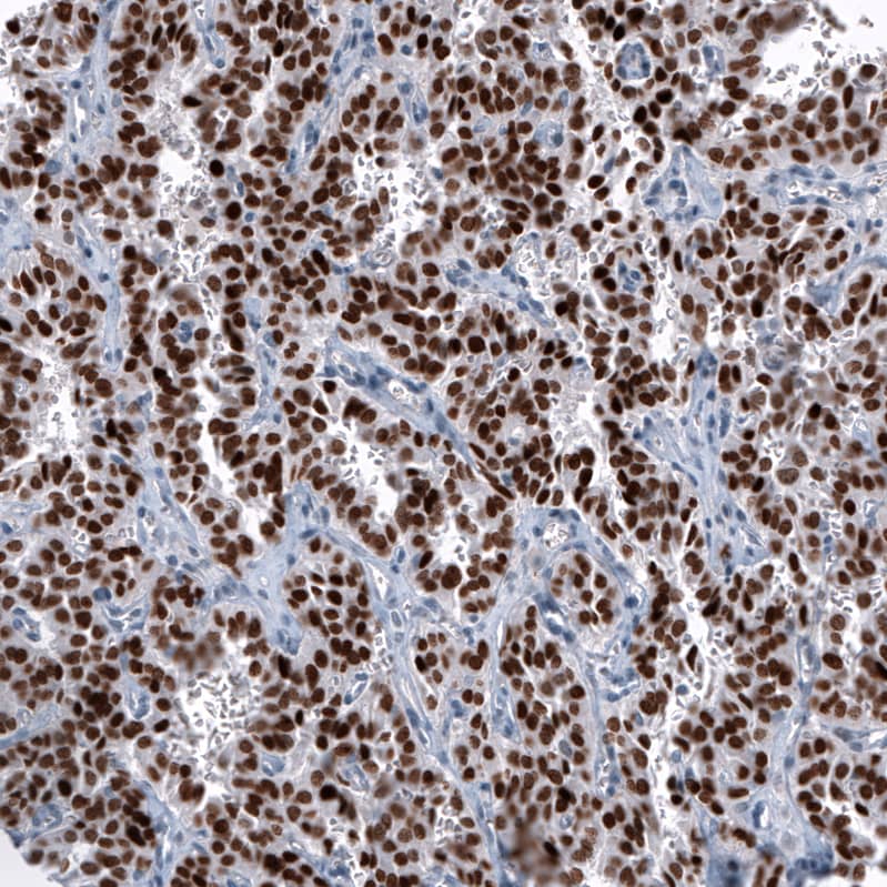 Staining of human lung tumor (typical carcinoid) shows strong nuclear positivity in tumor cells.