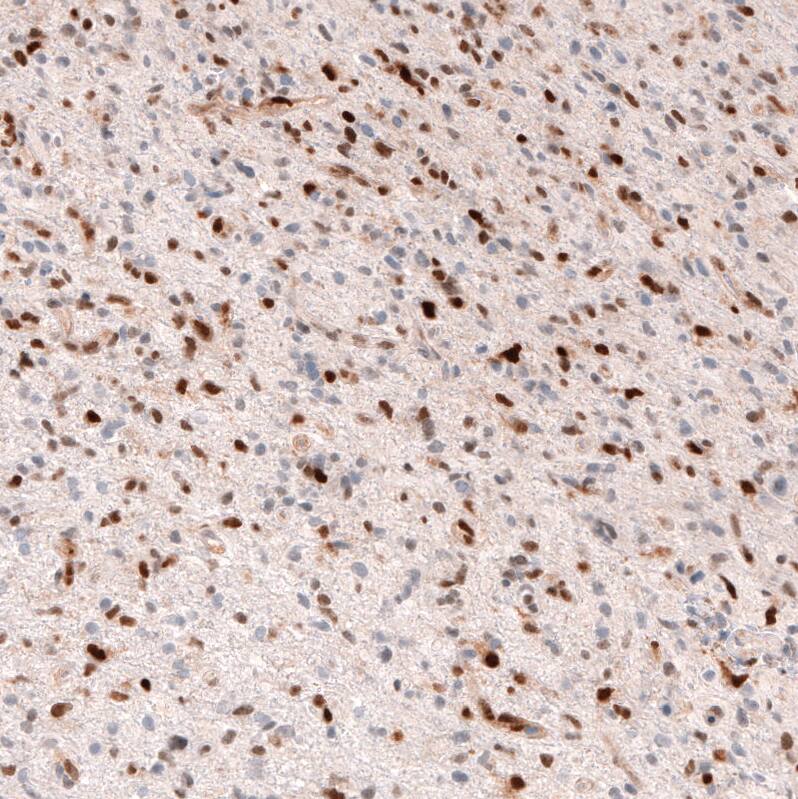 Staining of human glioma shows moderate to strong nuclear positivity in tumor cells.