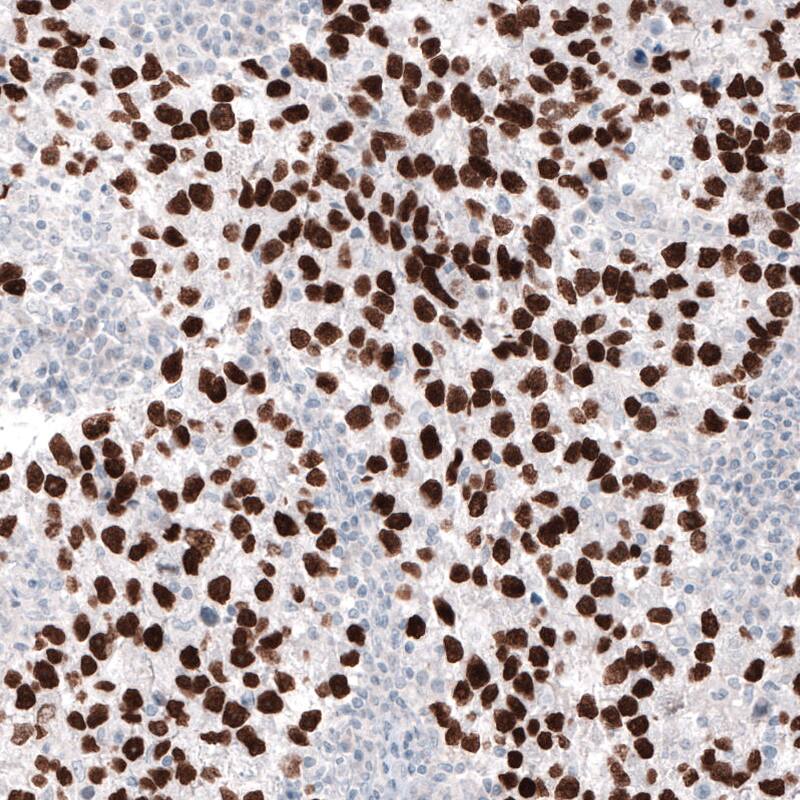 Staining of human testis cancer shows strong nuclear immunoreactivity in tumor cells.